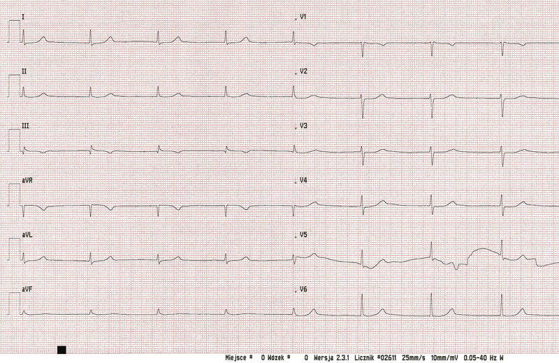 Rycina 2. Rytm z łącza przedsionkowo-komorowego zwolniony 45-50/min. Załamek P niewidoczny, musi znajdować się w obrębie zespołu QRS (pseudo-S w I, aVL oraz pseudo-r’ w V1, milimetrowe uniesienie końcówki zespołu QRS w III, aVF)