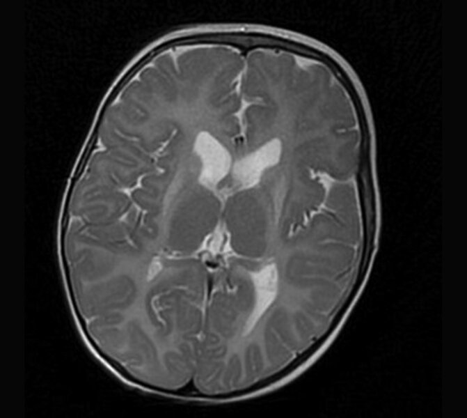 Rycina 2. Leukodystrofia hipomielinizacyjna z zanikiem zwojów podstawy i móżdżku (HLD6). MR, sekwencja T2. Rozległa hipomielinizacja oraz hiperintensywny sygnał zanikających, obkurczonych skorup. Dziewczynka 14-miesięczna z zespołem piramidowo-pozapiramidowym