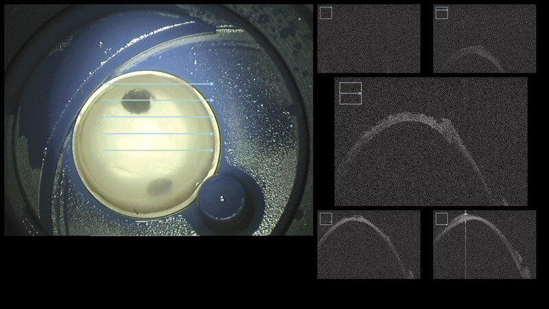 Ryc. 3. Obraz rogówki po rozwarstwieniu automatycznym nożem (mikrokeratomem). W obrazie OCT widoczna cienka część rogówki (0,1 mm), którą następnie przeszczepiamy.