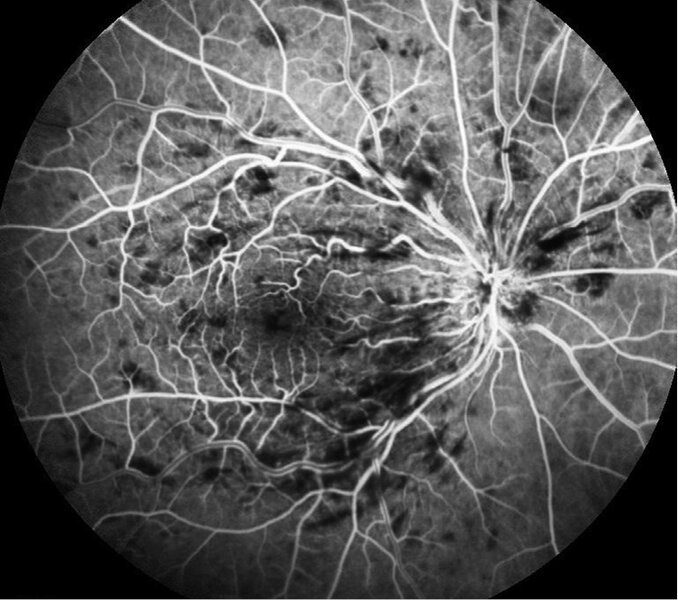 Rycina 4. Angiografia fluoresceinowa. Zakrzep żyły centralnej siatkówki, wczesna faza żylna