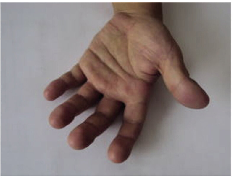 Rycina 6. Rumień dłoni (erythema palmare).