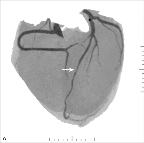 RYCINA 2. [A] Rekonstrukcja MIP Inversion. Obraz tętnic wieńcowych z drobnym mostkiem mięśniowym w segmencie 8 (strzałka). [B] Rekonstrukcja VR (volume rendering) – obraz prawidłowych tętnic wieńcowych. Mostek mięśniowy zaznaczony strzałką.