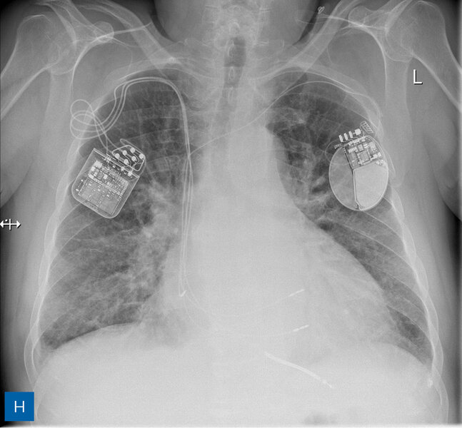 Rycina 1. Obraz radiologiczny w procesie identyfikacji kardiologicznego urządzenia wszczepialnego (CIED). A. Rozrusznik dwujamowy. B. Kardiowerter-defibrylator dwujamowy. C. Kardiowerter-defibrylator podskórny. D. Urządzenie do terapii resynchronizującej z funkcją defibrylacji E. Pętlowy rejestrator zdarzeń oraz rozrusznik dwujamowy. F. Stymulator bezelektrodowy typu Micra. G. Stymulator bezelektrodowy Abbott AVEIR. H. Układ poprawiający kurczliwość mięśnia sercowego (strona prawa) oraz kardiowerter-defibrylator jednojamowy (strona lewa)