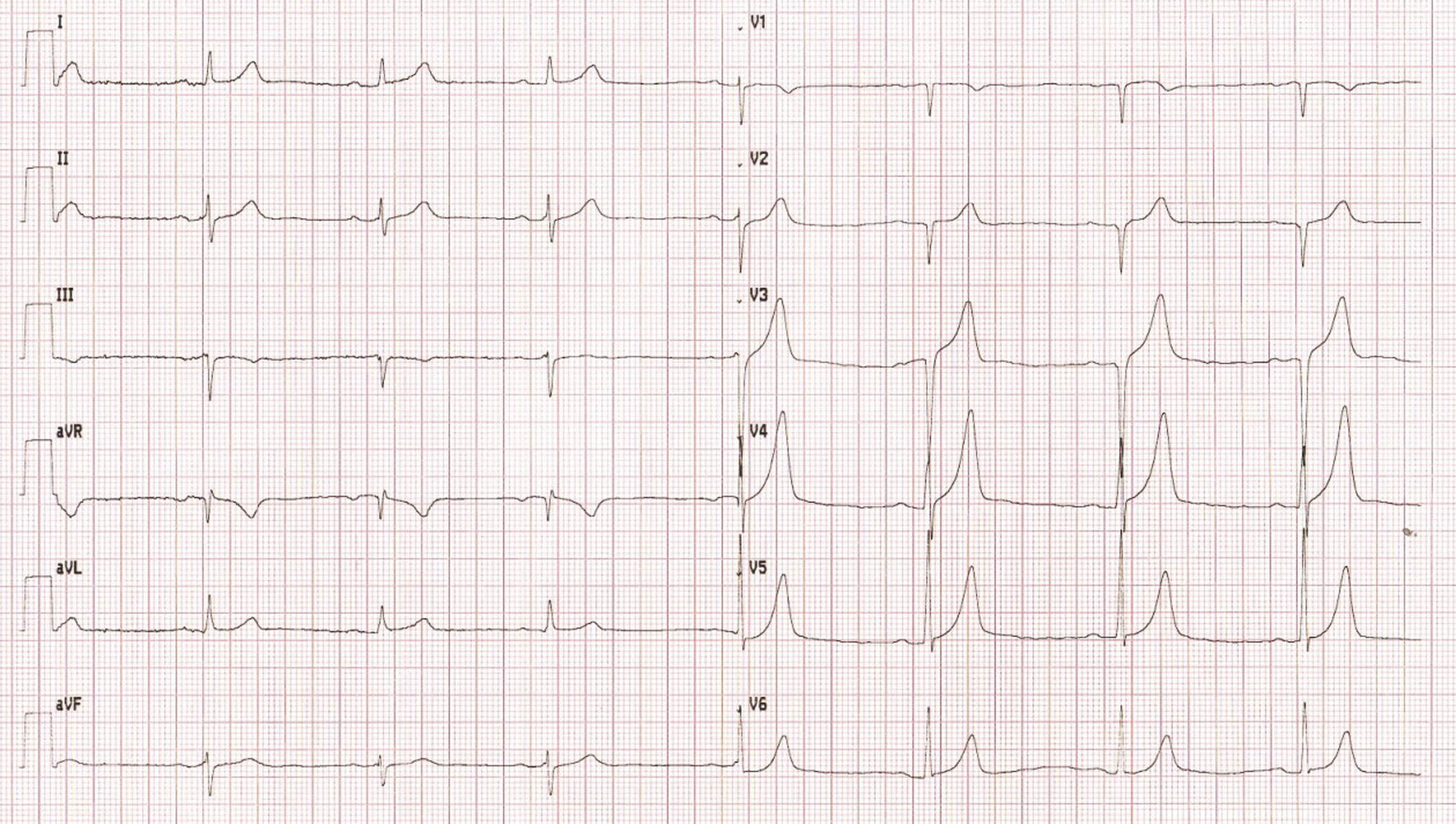 Rycina 2. Badanie elektrokardiograficzne, przesuw 25 mm/s, amplituda 10 mV. Zapis typowy dla osoby uprawiającej sport. Bradykardia zatokowa 44/min, oś serca pośrednia (-28°), blok przedsionkowo-komorowy I stopnia, cechy przerostu lewej komory, wysokie odejście punktu J w odprowadzeniach V3 i V4