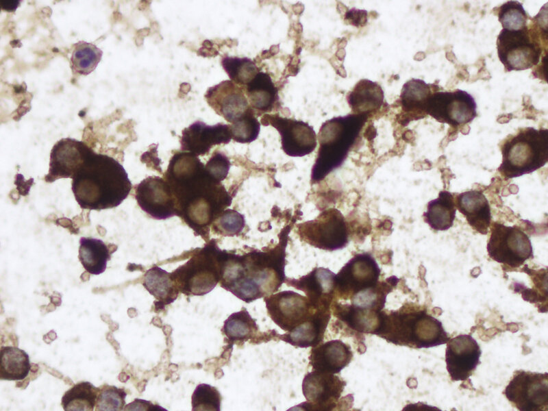 Fot. 3. Preparaty z biopsji aspiracyjnej cienkoigłowej – komórki raka rdzeniastego tarczycy; barwienie IHC – kalcytonina.