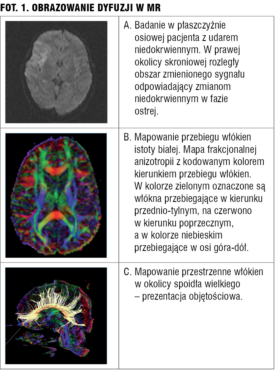 Użyteczność tomografii komputerowej i rezonansu magnetycznego w psychiatrii