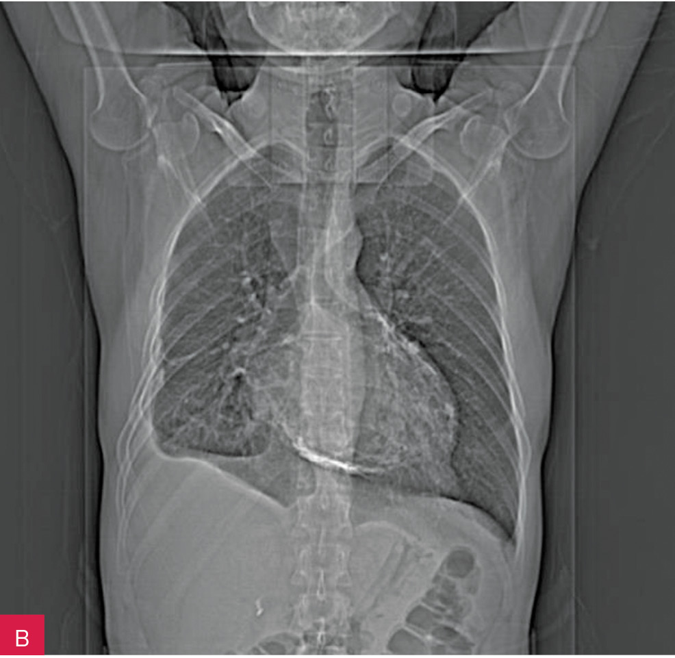 Rycina 5A i B. Badanie radiologiczne klatki piersiowej: zwapnienia w osierdziu