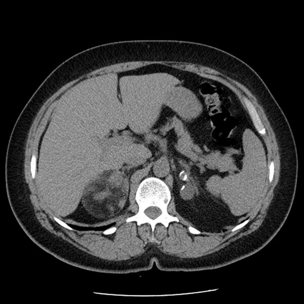 Rycina 3. Obraz TK: myelolipoma prawego nadnercza oraz lymphangioma lewego nadnercza
