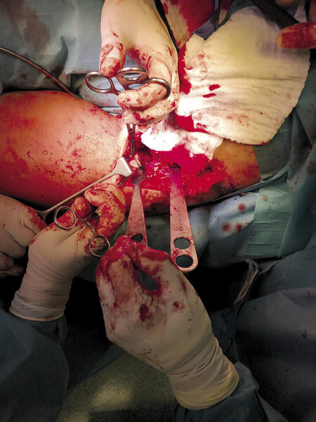 Ryc. 1. Dostęp operacyjny do osteotomii okołopanewkowej, fotografia śródoperacyjna.