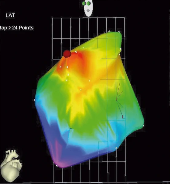 Rycina 1. Mapa aktywacji prawego przedsionka uzyskana systemem elektroanatomicznym CARTO u pacjenta z ogniskowym częstoskurczem przedsionkowym.