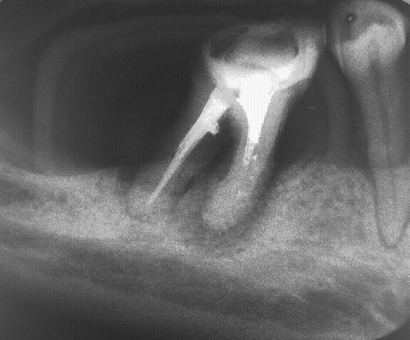 Ryc. 2. Ząb 47 po leczeniu endodontycznym i 30 zabiegach magnetostymulacji.