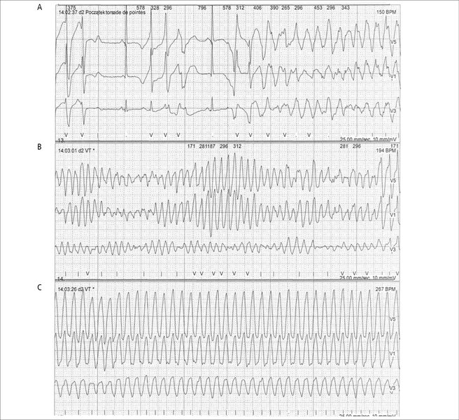 Rycina 1. Fragment holterowskiego zapisu EKG (przesuw papieru 25 mm/s).