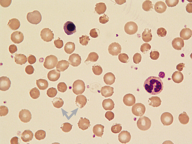 Rycina 1. Krew obwodowa – krwinki pęcherzykowe (blister cells)