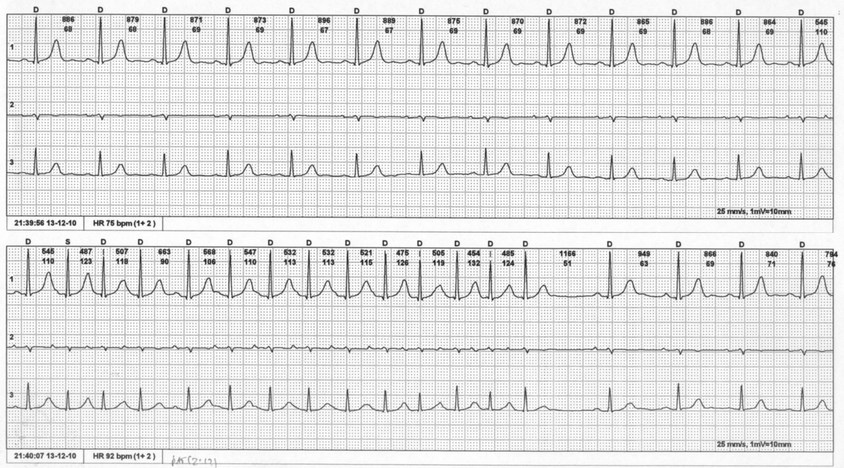 Ryc. 4. Epizod napadowego migotania przedsionków u pacjenta leczonego z powodu chłoniaka. Zapis EKG metodą Hotlera. Podczas leczenia pacjent zgłaszał „kołatanie serca” i z tego powodu wykonano zapis EKG metodą Holtera.