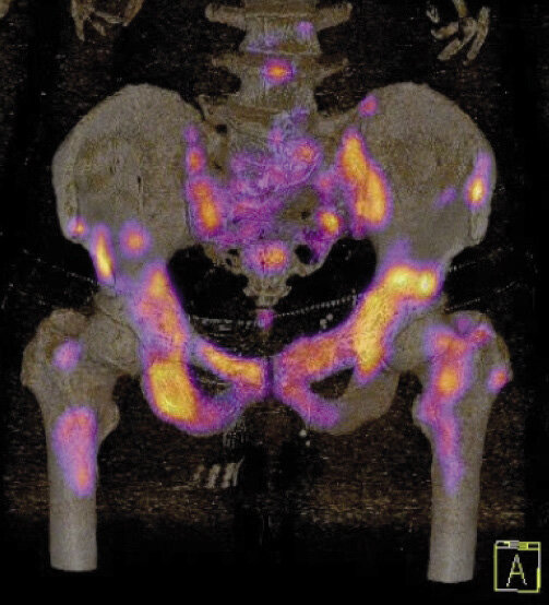 Ryc. 3. Badanie SPECT-CT po podaniu 99mTc-MDP (scyntygrafia kości). Zmiany przerzutowe do układu kostnego raka prostaty.