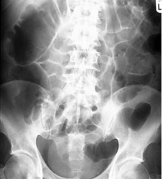  Rycina 4. Toksyczne rozdęcie okrężnicy, które może występować w ciężkiej postaci zakażenia C. difficile. Przeglądowe zdjęcie rentgenowskie jamy brzusznej przedstawiające rozdęcie jelita grubego z obrzękiem śluzówki (strzałka)