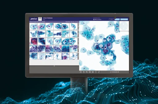 Nowoczesne rozwiązania w badaniach przesiewowych w kierunku raka szyjki macicy. Cytologia ThinPrep®, cyfrowa diagnostyka Genius™ i badanie Aptima® HPV mRNA