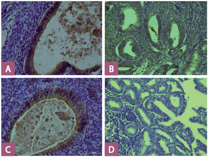Ryc. 3. A – obecna ekspresja błonowa DcR1 w prawidłowym endometrium (powiększenie 400 ×); B – obecna ekspresja błonowa DcR1 w raku endometrium (powiększenie 400 ×); C – obecna ekspresja błonowa DcR2 w prawidłowym endometrium (powiększenie 400 ×); D – brak ekspresji błonowej DcR2 w raku endometrium (powiększenie 400 ×).