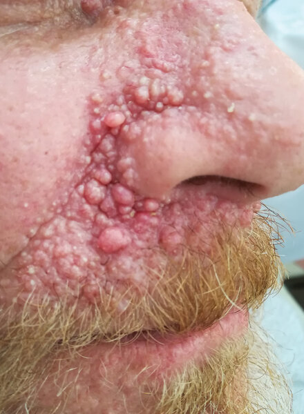Rycina 2. Liczne nabłoniaki włosowe (klasyczne trichoepithelioma, cribriform trichoblastoma) w okolicach fałdu nosowo-policzkowego, górnej wargi oraz przyśrodkowych części powiek w zespole mnogich rodzinnych nabłoniaków włosowych (multiple familial trichoepithelioma) u mężczyzny w średnim wieku
