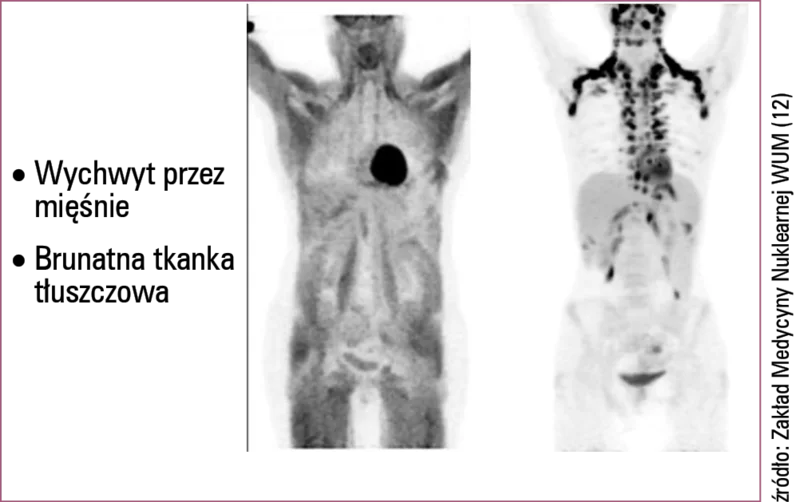 
 
 
 
 Artefakty w badaniu PET/CT z 18FDG.