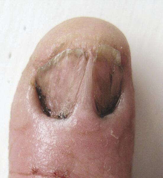 Ryc. 4. Skrzydlik (pterygium).