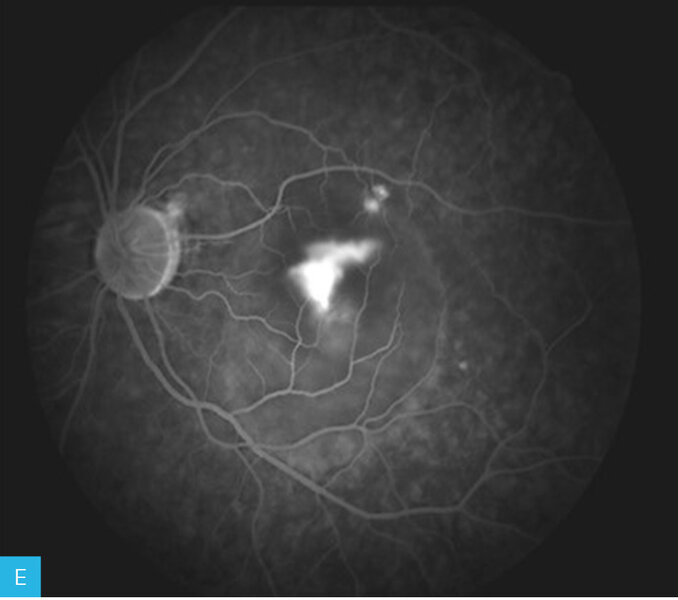 Rycina 13A-F. Angiogram oka lewego