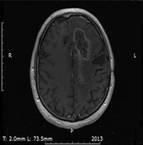 3. Badanie MRI 29 tygodni po rozpoczęciu leczenia.