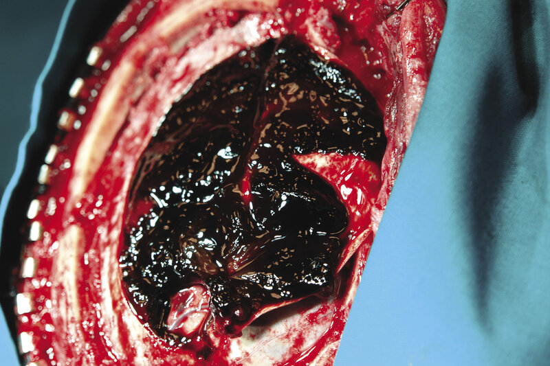 Rycina 5. Kraniotomia. Widoczne otwarcie kostne, skrzepły krwiak oraz mózg pod warstwą krwiaka w dolnej części fotografii