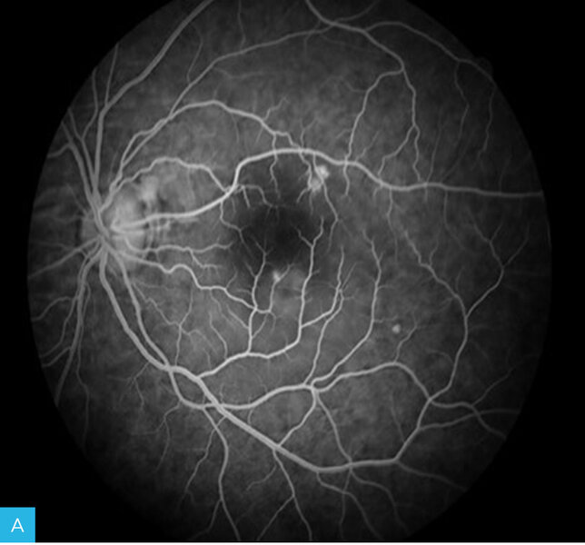 Rycina 13A-F. Angiogram oka lewego