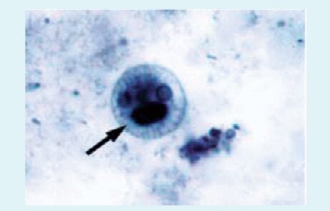  Rycina 2. Morfologia klasycznych cyst Entamoeba histolytica/dispar/moshkovskii (barwienie złożone żelazo-hematoksylina rozmazu kału, oryginalne powiększenie × 1000). Średnica cyst wynosi 10-16 μm (średnio 12,5 μm), każda zawiera do 4 jąder z centralnym kariosomem i obwódką chromatyny. Jak widać powyżej wszystkie 4 jądra są rzadko widoczne w tej płaszczyźnie ogniska. Często widoczne są ciałka chromatoidalne (krystalizowane rybosomy). Morfologia ta pozwala wprawdzie na identyfikację trzech pierwotniaków, precyzyjne rozróżnienie gatunków wymaga jednak dalszych badań.