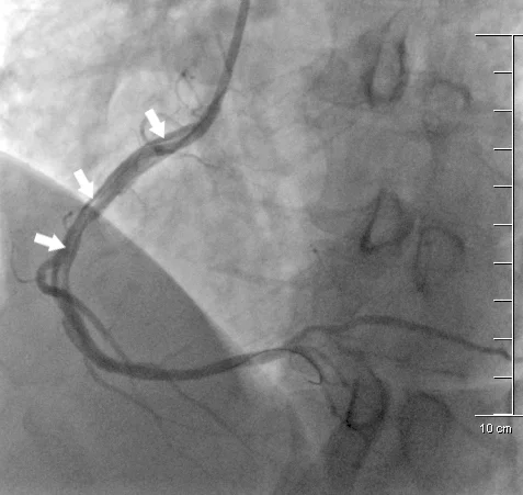 Rycina 8. Angiogram przedstawiający spiralną dyssekcję prawej tętnicy wieńcowej (strzałki). Uwagę zwraca głęboka intubacja naczynia oraz niewspółosiowe ustawienie końcówki cewnika prowadzącego.