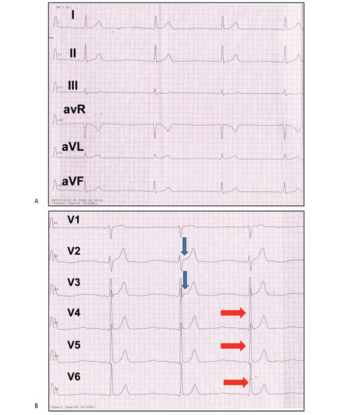 Rycina 6 A i B. Chłopiec w wieku 17 lat, trenujący wyczynowo biegi na 10 km, pływanie, rugby. EKG – normogram, rytm zatokowy 42/min, bradykardia zatokowa, czas PQ 0,12 s, czas QRS 0,1 s, czas QT 0,36 s, zespół wczesnej repolaryzacji komór (uniesienie punktu J w odprowadzeniach przedsercowych prawokomorowych – strzałka niebieska), podwyższona amplituda załamków R w odprowadzeniach V4-V6 (czerwone strzałki) bez innych cech przerostu lewej komory (izolowane „woltażowe cechy przerostu lewej komory”).