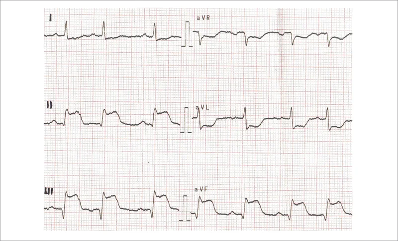 Rycina 1. EKG 59-letniego mężczyzny z wywiadem 3-godzinnego bólu zamostkowego z zawałem ściany dolnej leczonego pierwotną PCI.