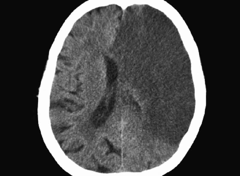 Ryc. 1. Objawy radiologiczne – udar półkulowy.