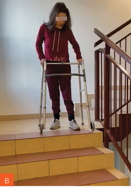 Rycina 8A-C. Wielomiesięczne usprawnianie chodu u młodej pacjentki po porażeniu czterokończynowym, która w ostrej fazie wymagała zastosowania wentylacji mechanicznej
