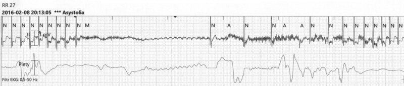 Rycina 2. Przyłóżkowy zapis EKG w trakcie wymiotów (przesuw papieru 12,5 mm /s, II standardowe odprowadzenie EKG) u 5-miesięcznego niemowlęcia. Początkowo częstotliwość rytmu serca wynosiła 136/min, następnie asystolia 7280 ms, po której widoczna jest niemiarowa bradykardia trwająca 7200 ms (5 kolejnych pobudzeń oznaczonych literą N) i powrót do rytmu sprzed incydentu 135/min