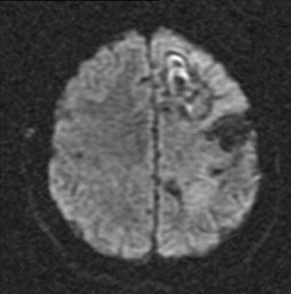 6. Badanie MRI w sekwencji DWI w trakcie leczenia.