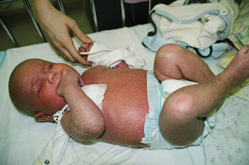 Rycina 2. Erytrodemia u dziecka z ciężkim złożonym niedoborem odporności (w zespole Omenna).