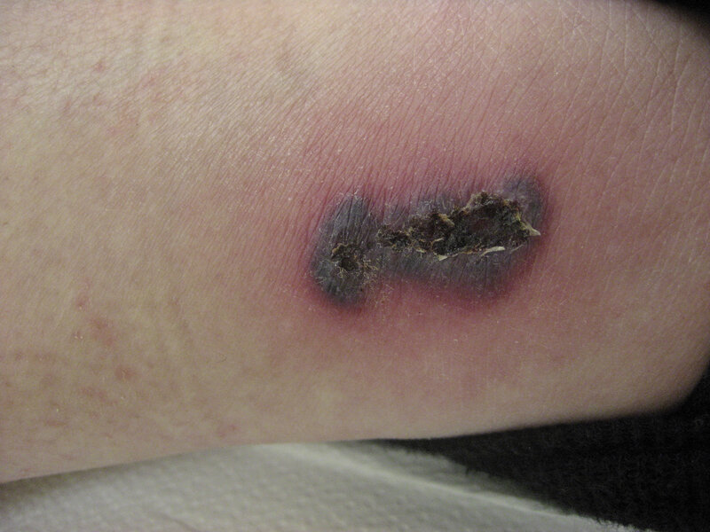 Ryc. 5. Pyoderma gangrenosum przypominająca zapalenie naczyń (zmiana w obrębie podudzia).