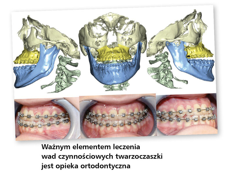 Rewolucja w ortognatyce