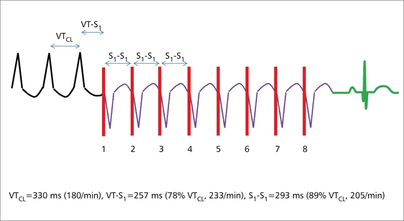 Rycina 1. Stymulacja antytachyarytmiczna (ATP) typu burst.