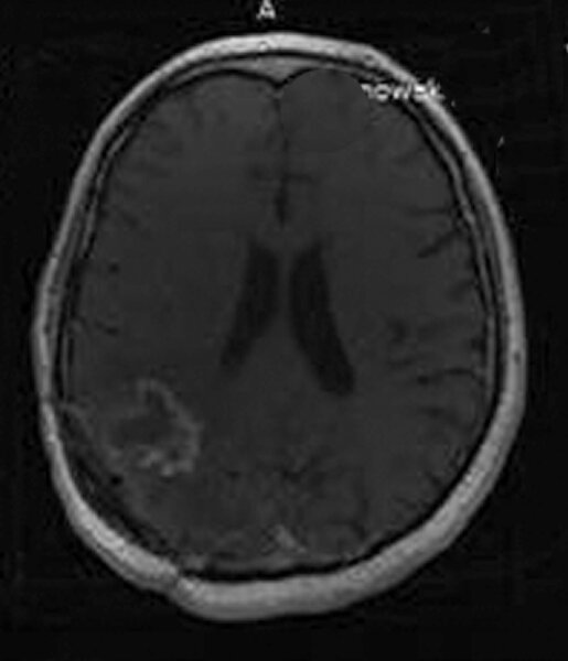 4. Badanie MRI 6 tygodni po ostatnim podaniu 213Bi-SP.