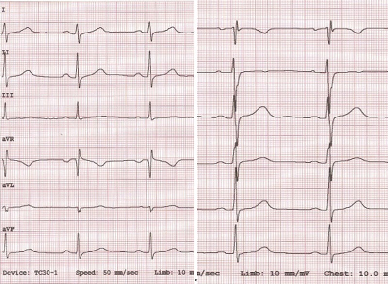 Rycina 9. EKG dziecka 13-letniego.