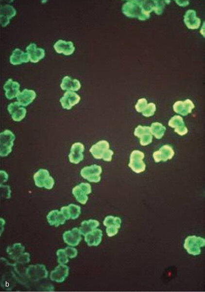 Rycina 1. Identyfikacja przeciwciał przeciwko cytoplazmie neutrofilów (ANCA) metodą immunofluorescencji pośredniej. (a) ANCA typ cytoplazmatyczny: dodatnie znakowanie w cytoplazmie neutrofilów z obecnością ziarnistości i immunofluorescencją pomiędzy segmentami jąder komórkowych. (b) ANCA typ okołojądrowy: immunofluorescencja widoczna wokół jąder neutrofilów.
