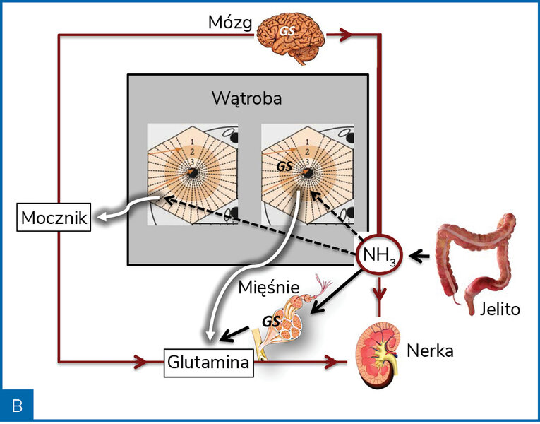 Rycina 2. Poglądowa rycina przedstawiająca metabolizm amoniaku (NH3) w warunkach zdrowia (A) i marskości wątroby (B)