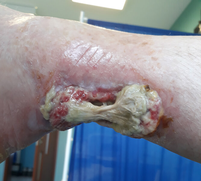 Rycina 4. Okolica prawego stawu skokowego. Strona przyśrodkowa. Radioterapia 45 lat temu z powodu hemangioendothelioma dystalnego odcinka piszczeli. Stan po leczeniu ropnia (zakażonego krwiaka) okolicy ścięgna Achillesa. Ubytek skóry i tkanki podskórnej po chirurgicznym usunięciu części zmian martwiczych ścięgna Achillesa. Od strony pięty (dystalna część rany) i od strony łydki (proksymalna część rany) widoczna ziarnina zaczynająca wypełniać ubytek po martwicy tkanek. Obraz 10 tygodni po ostatnim opatrunku typu VAC