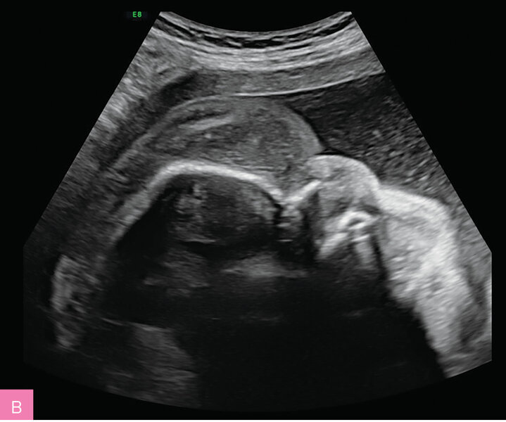 Rycina 7A, B. 23 tydzień ciąży (A) i 32 tydzień ciąży (B); C II, P II. Obrzęk płodu obserwowany od 20 tygodnia ciąży. Łagodna niedokrwistość płodu. Nie stwierdzono wad strukturalnych. Uwagę zwracały ogromny obrzęk tkanki podskórnej, obejmujący twarz, kończyny górne i dolne oraz mosznę, a także znaczne powiększenie wątroby. Od 30 tygodnia ciąży obserwowano wielowodzie. Wynik badania aCGH prawidłowy. Ujemne wyniki badania w kierunku wybranych chorób metabolicznych z płynu owodniowego i badania przesiewowego w kierunku najczęstszych chorób monogenowych z kropli krwi płodu, pobranej na drodze kordocentezy. PPROM w 35 tygodniu ciąży. Zgon okołoporodowy. Za pomocą GS udało się ustalić znany patogenny intronowy wariant w genie PIEZO1 odpowiadający za uogólnioną dysplazję limfatyczną, co odpowiadało obserwowanemu fenotypowi