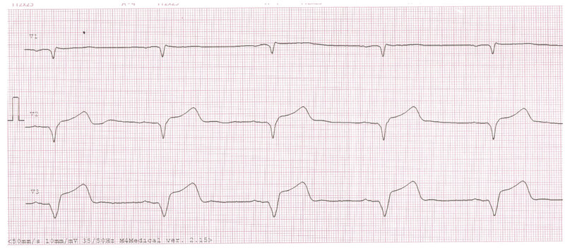 Rycina 1. Elektrokardiogram pacjenta z zawałem mięśnia sercowego z uniesieniem odcinka ST (STEMI) ściany przedniej. Przesuw 50 mm/s. Rytm zatokowy, 63/min, lewogram, blok przedniej wiązki lewej odnogi pęczka Hisa, cechy martwicy w obrębie ściany przedniej, ostry zespół wieńcowy z uniesieniem odcinka ST ściany przedniej (2 doba zawału). W odprowadzeniach V4-V5 pojawiają się ujemne załamki T