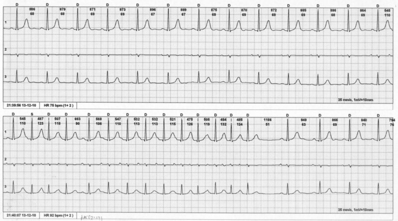 Ryc. 4. Epizod napadowego migotania przedsionków u pacjenta leczonego z powodu chłoniaka. Zapis EKG metodą Hotlera. Podczas leczenia pacjent zgłaszał „kołatanie serca” i z tego powodu wykonano zapis EKG metodą Holtera.