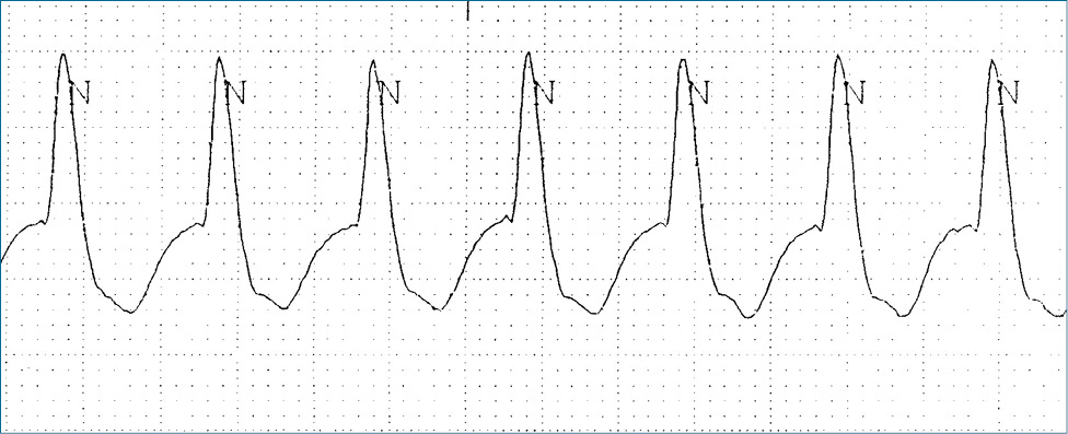 
 
 Rycina 2. Fragment zapisu EKG z monitora w dużym powiększeniu. Widoczne szerokie zespoły QRS, częstość akcji serca 148/min